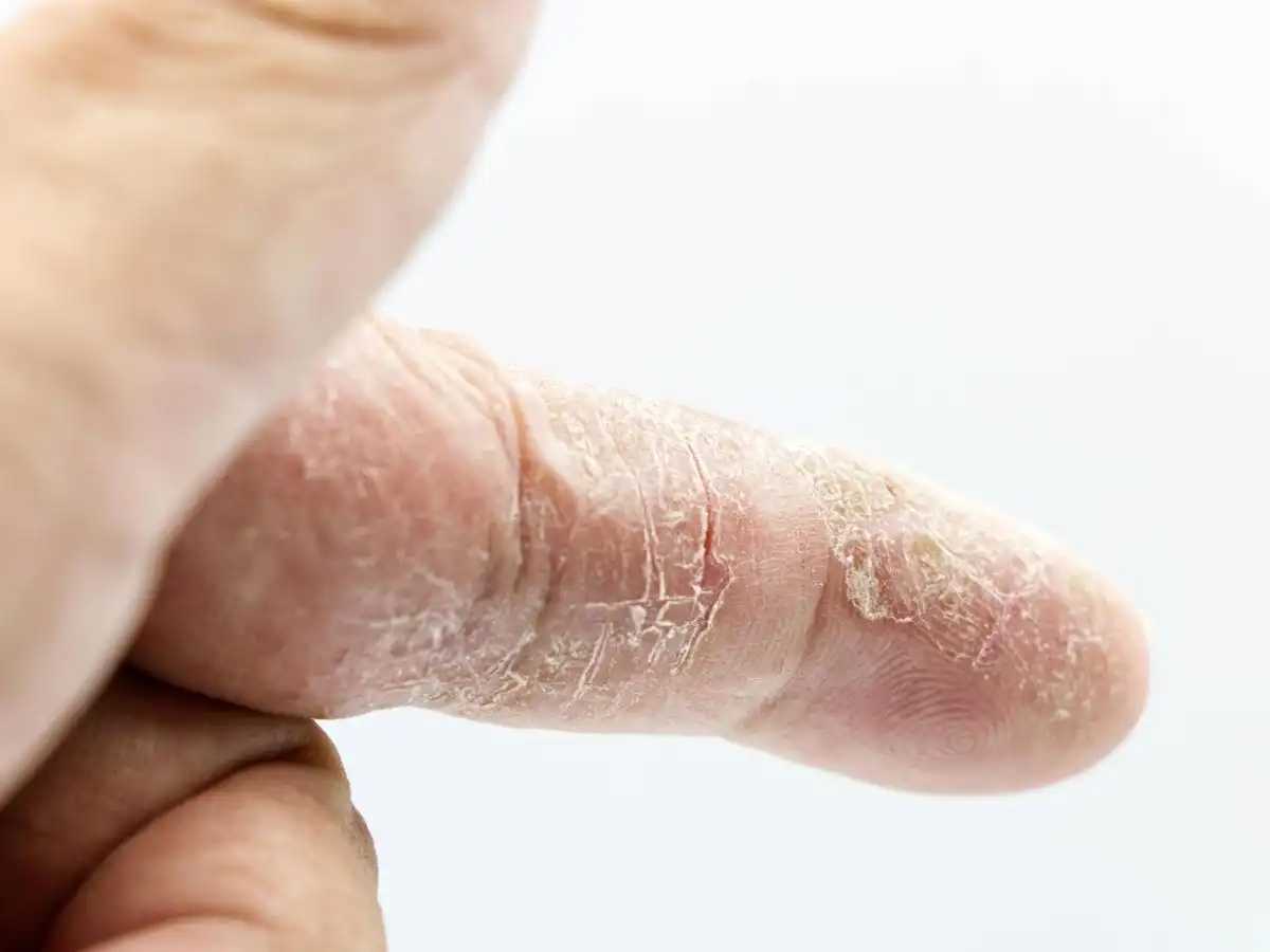 Các bệnh lý về da có thể gây khô da nghiêm trọng Các bệnh lý về da có thể gây khô da nghiêm trọng