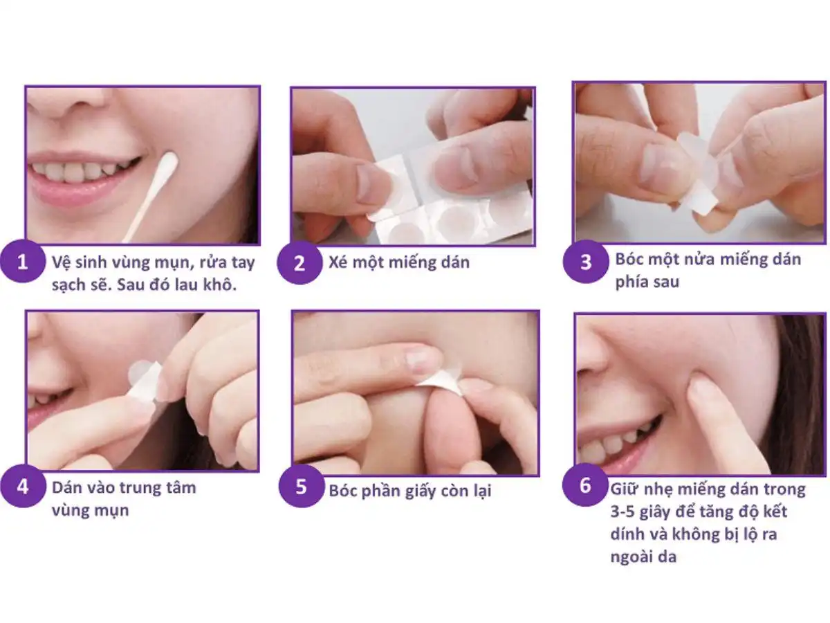 Cách dùng miếng dán mụn đúng chuẩn Cách dùng miếng dán mụn đúng chuẩn
