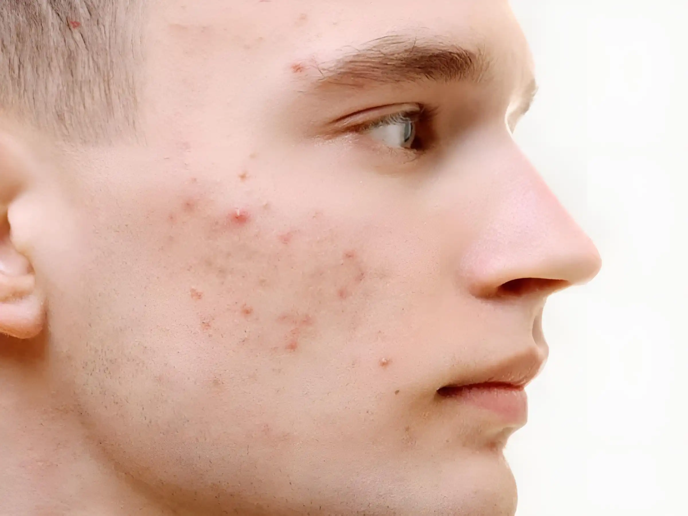 Cách trị mụn trứng cá cho nam giới có khác nữ giới không? Cách trị mụn trứng cá cho nam giới có khác nữ giới không?