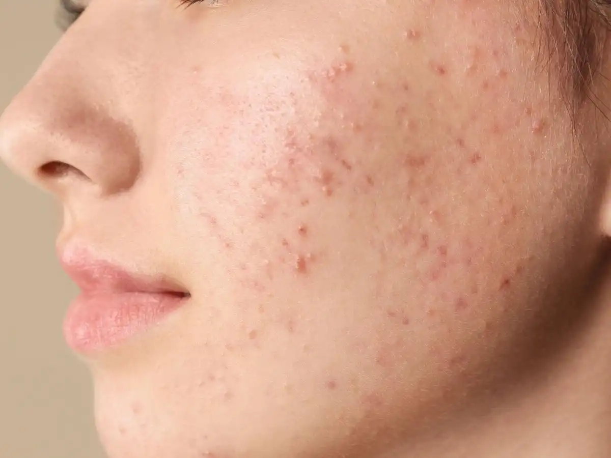 Chăm sóc da mụn cẩn thận để phục hồi hiệu quả