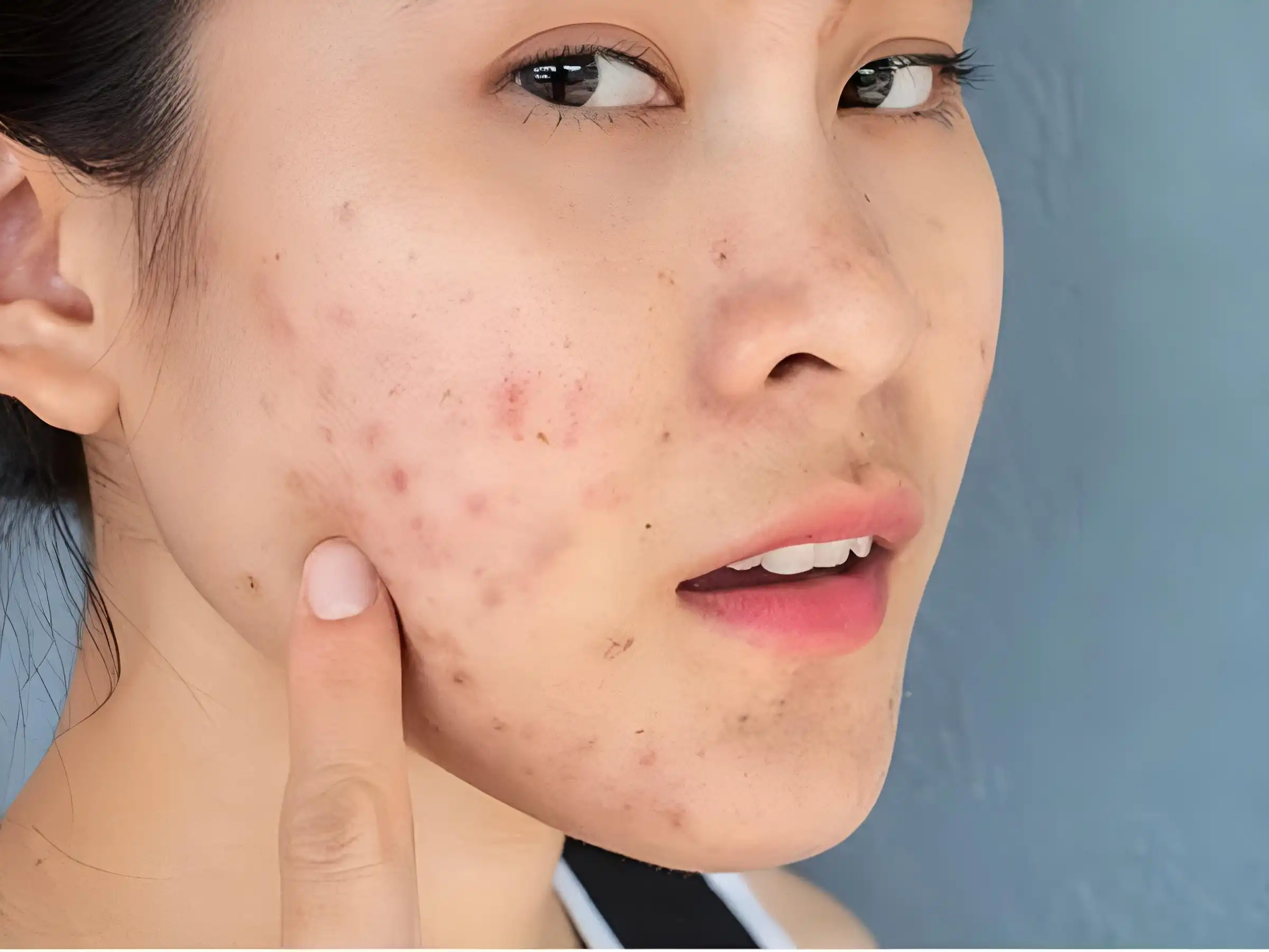 Có cần thay đổi chu trình skincare khi hết mụn không? Có cần thay đổi chu trình skincare khi hết mụn không?