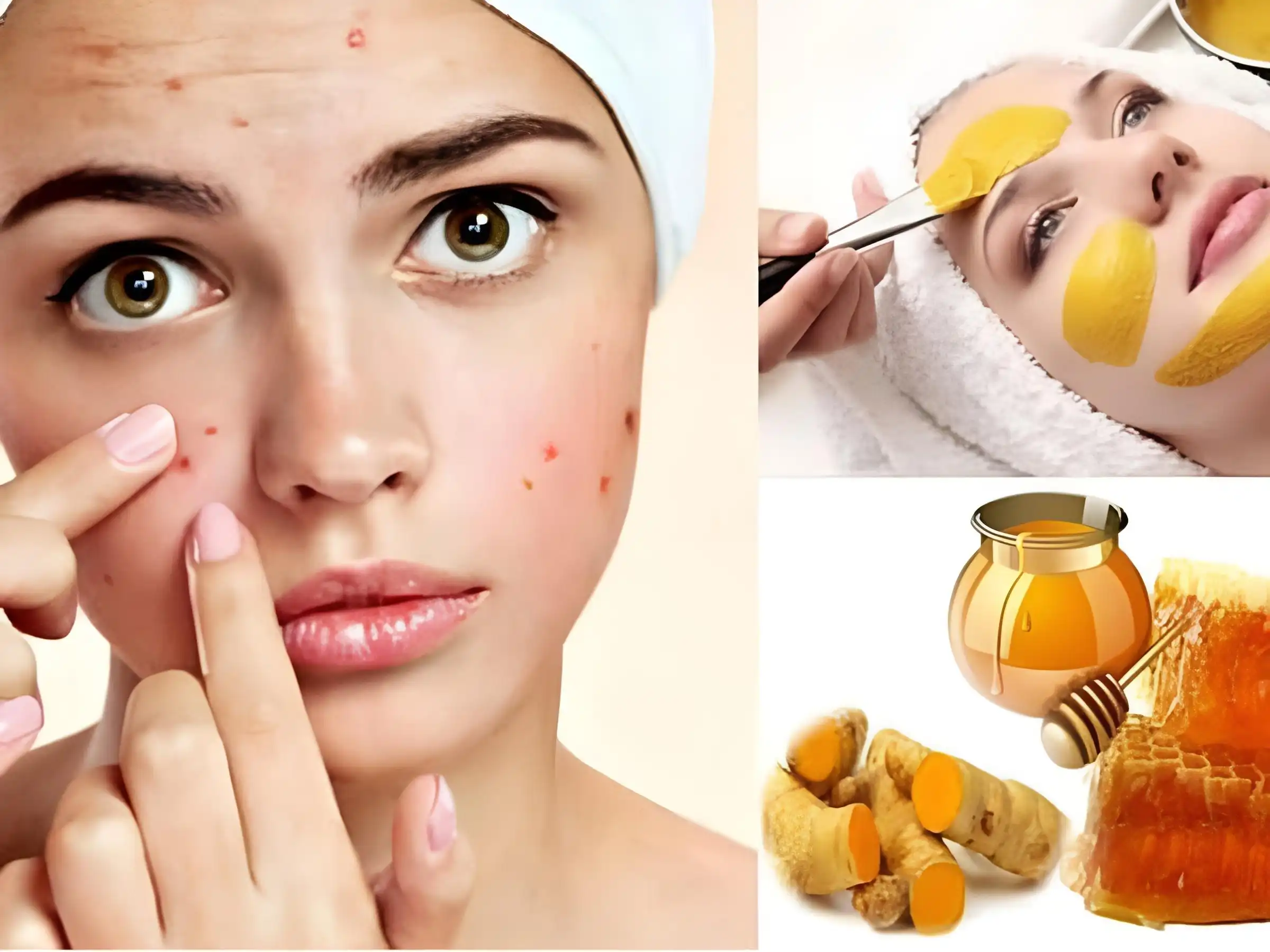 Công thức này được nhiều người tin dùng vì vừa trị mụn, vừa ngừa sẹo thâm khó chịu Công thức này được nhiều người tin dùng vì vừa trị mụn, vừa ngừa sẹo thâm khó chịu