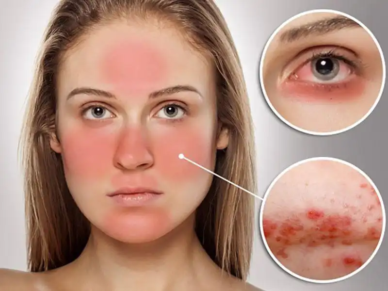 Da mỏng rất nhạy cảm với các thành phần hóa học có trong mỹ phẩm Da mỏng rất nhạy cảm với các thành phần hóa học có trong mỹ phẩm