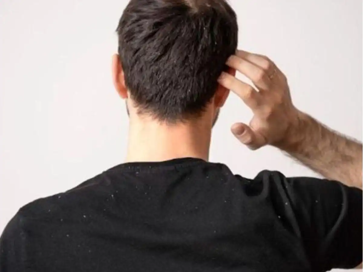 Dấu Hiệu Nhận Biết Gàu Trên Tóc Nam Dấu Hiệu Nhận Biết Gàu Trên Tóc Nam