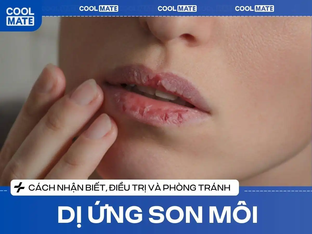 Dị Ứng Son Môi: Cách Nhận Biết, Trị & Phòng Tránh Cực Dễ