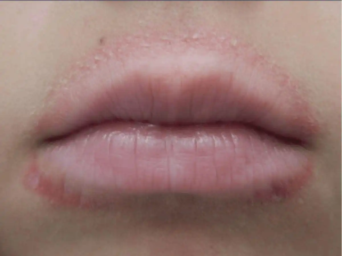 Dị ứng son môi là gì?
