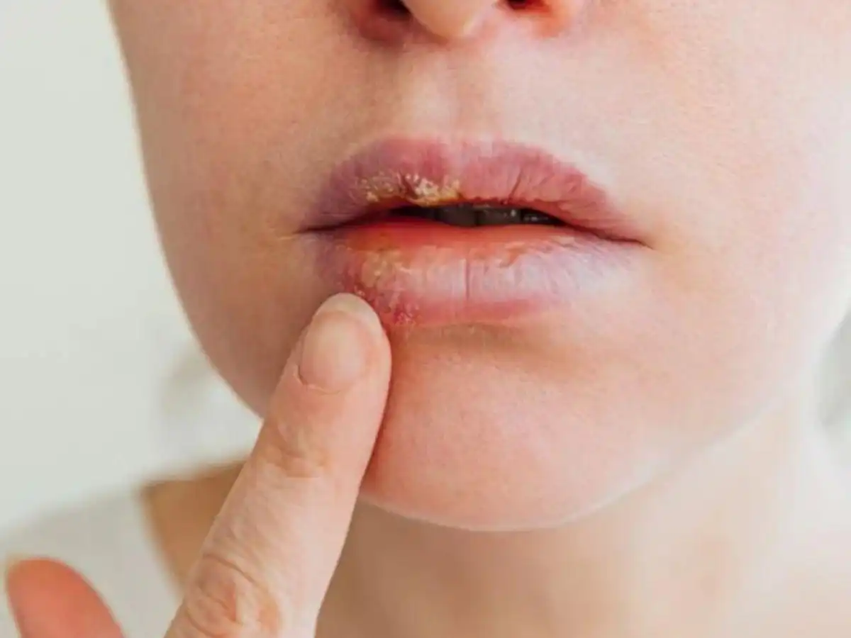Đôi môi bị khô, bong tróc nhẹ do kích ứng mỹ phẩm