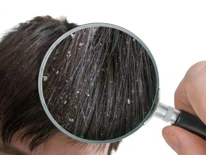 Gàu là gì? Lý do khiến tóc bị gàu là gì?