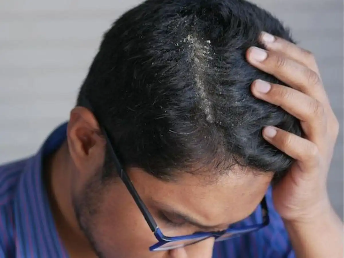 Gàu là tình trạng da đầu bị bong tróc các tế bào chết thành từng mảng vảy nhỏ màu trắng hoặc vàng nhạ Gàu là tình trạng da đầu bị bong tróc các tế bào chết thành từng mảng vảy nhỏ màu trắng hoặc vàng nhạ