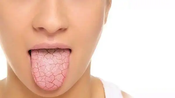 Khô miệng gây hôi miệng Khô miệng gây hôi miệng