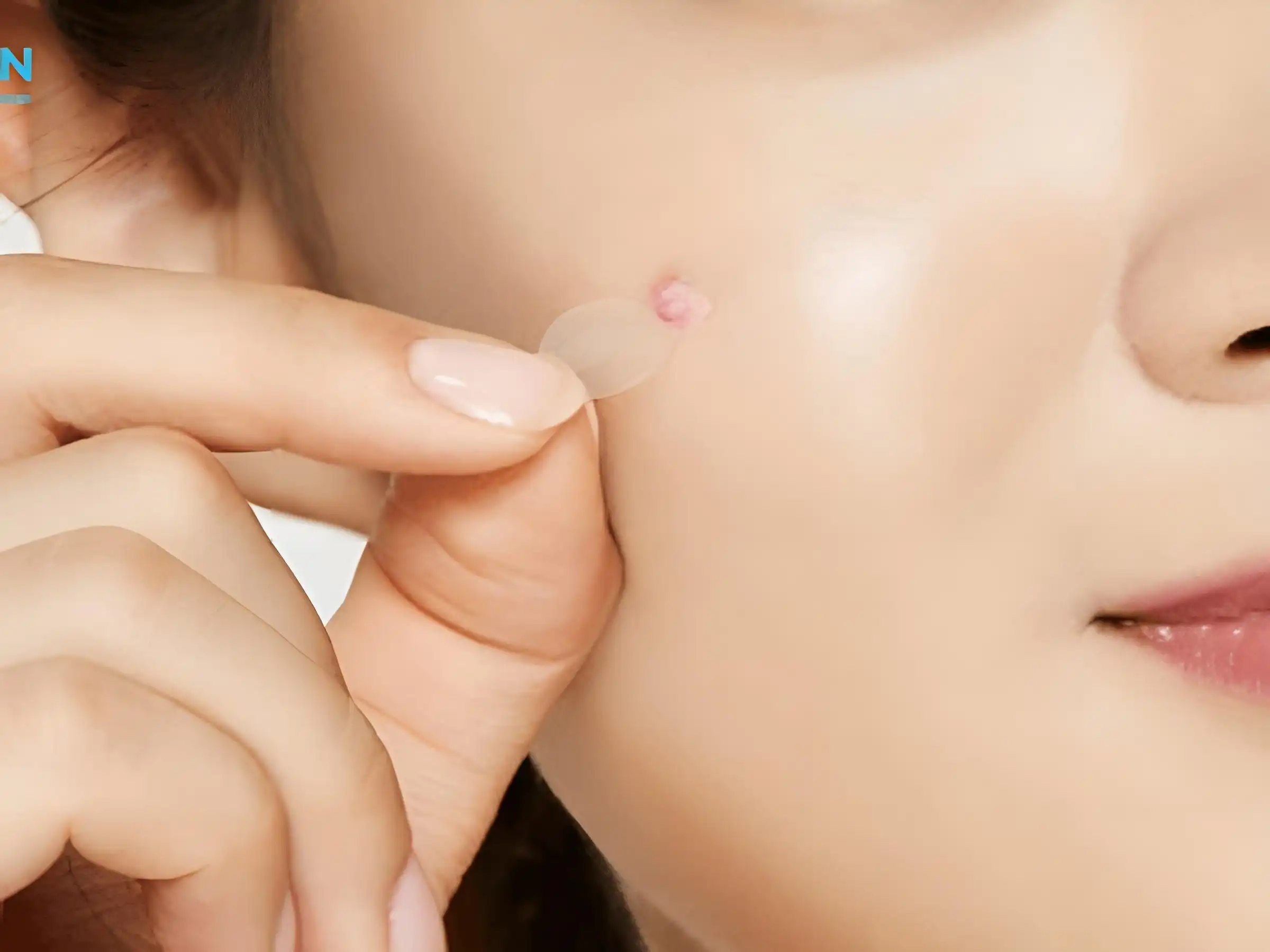 Miếng dán mụn chính là vệ sĩ tí hon cho các nốt mụn sưng viêm Miếng dán mụn chính là vệ sĩ tí hon cho các nốt mụn sưng viêm