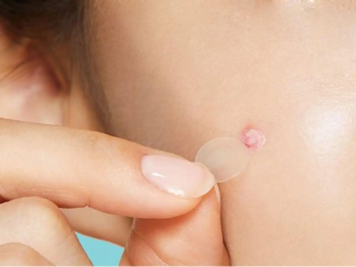 Miếng dán mụn thường làm từ hydrocolloid Miếng dán mụn thường làm từ hydrocolloid