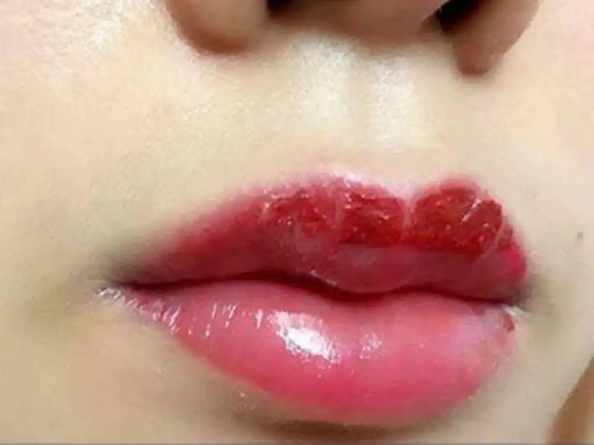 Môi khô, bong tróc, mất nhiều thời gian để môi phục hồi sau phun Môi khô, bong tróc, mất nhiều thời gian để môi phục hồi sau phun