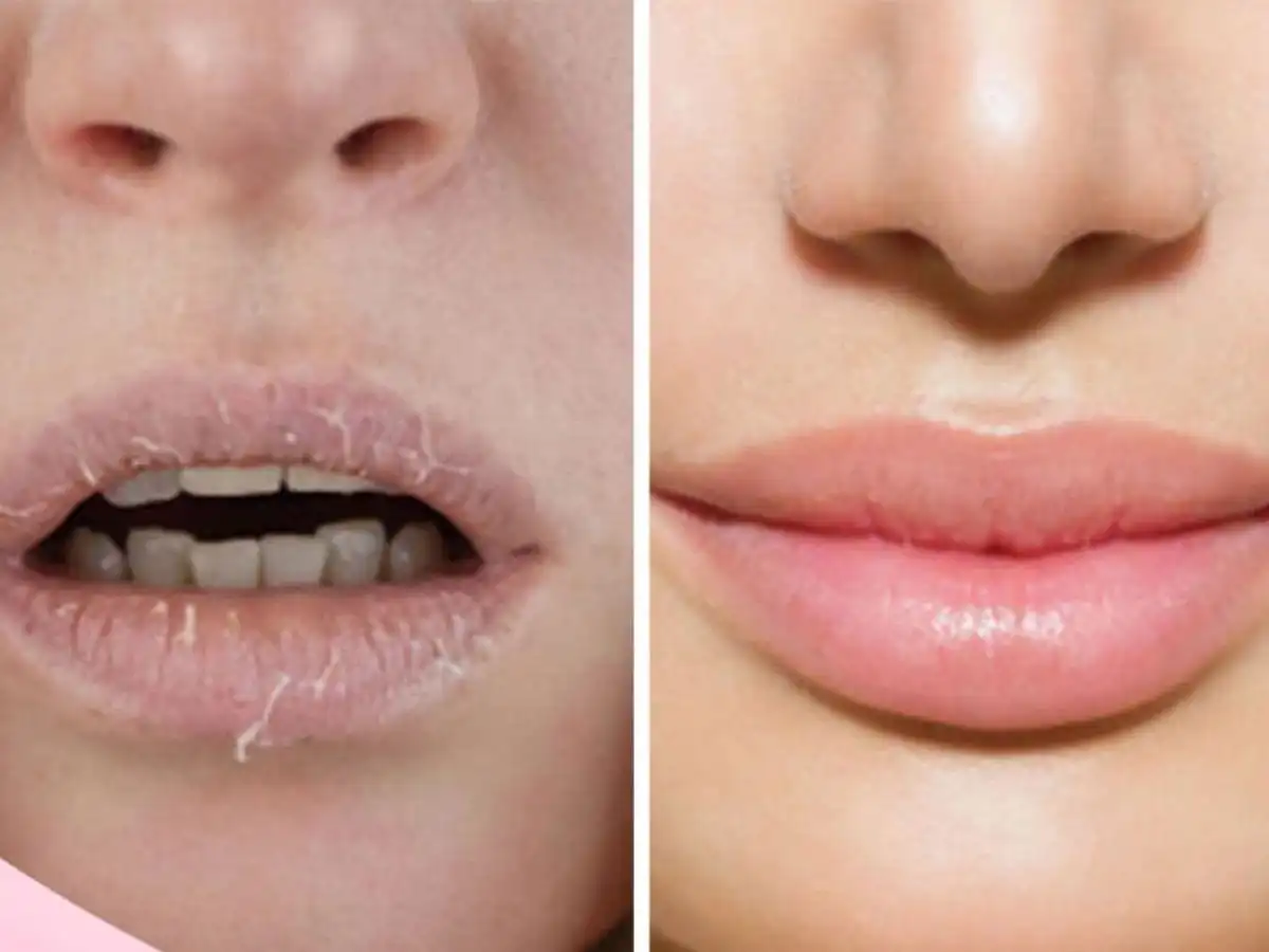 Môi Khô Nứt Nẻ Là Do Đâu? Môi Khô Nứt Nẻ Là Do Đâu?