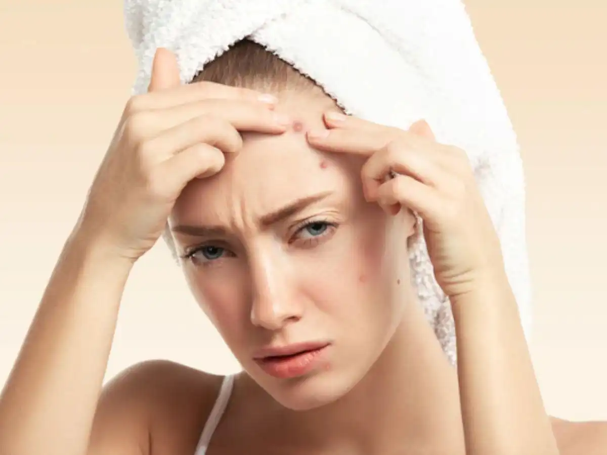 Nặn mụn sai cách dễ gây viêm nhiễm nặng hơn, để lại sẹo rỗ Nặn mụn sai cách dễ gây viêm nhiễm nặng hơn, để lại sẹo rỗ