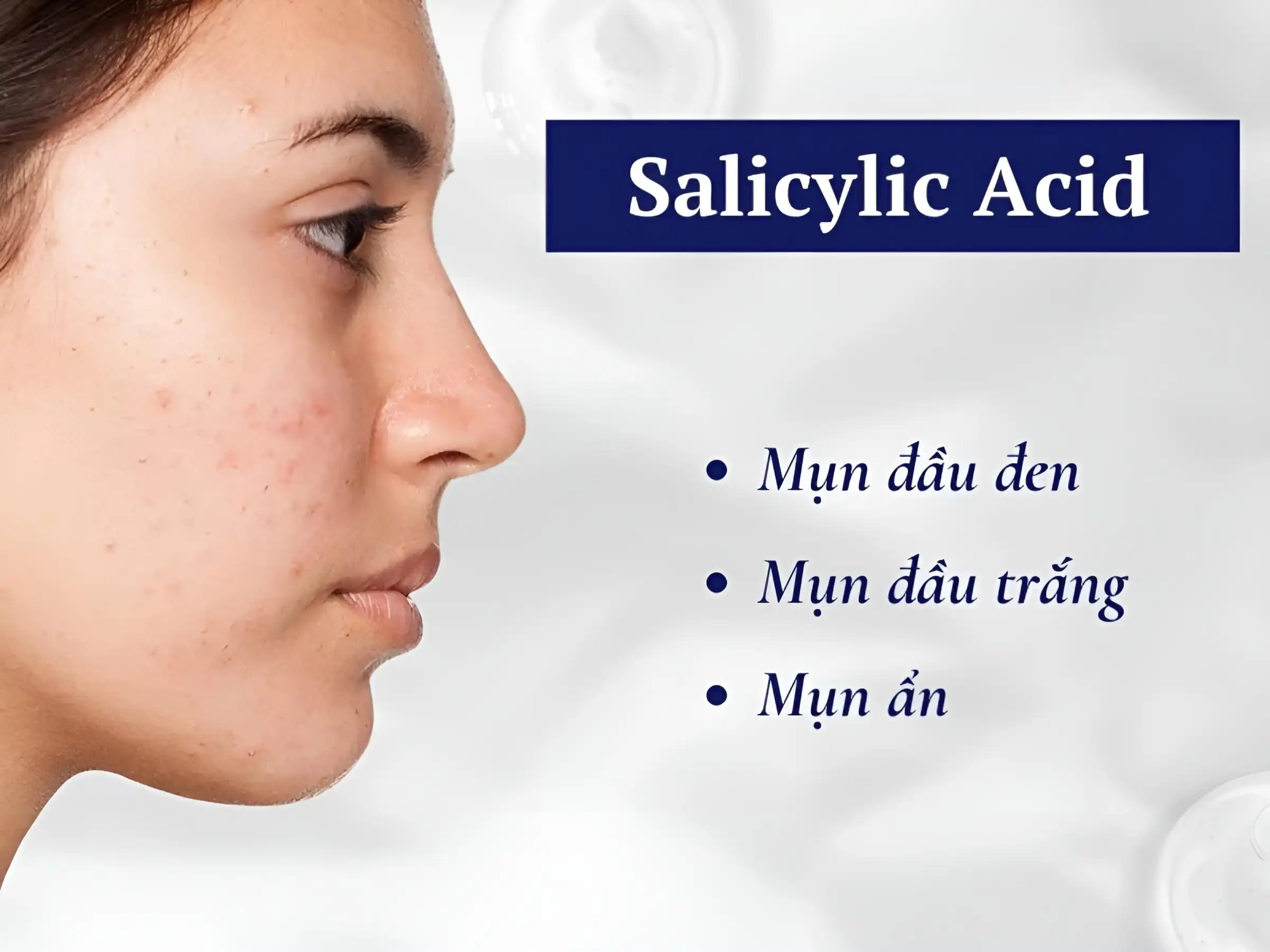 Salicylic Acid là vị cứu tinh cho ai hay bị mụn ẩn, mụn đầu đen hoặc lỗ chân lông to Salicylic Acid là vị cứu tinh cho ai hay bị mụn ẩn, mụn đầu đen hoặc lỗ chân lông to