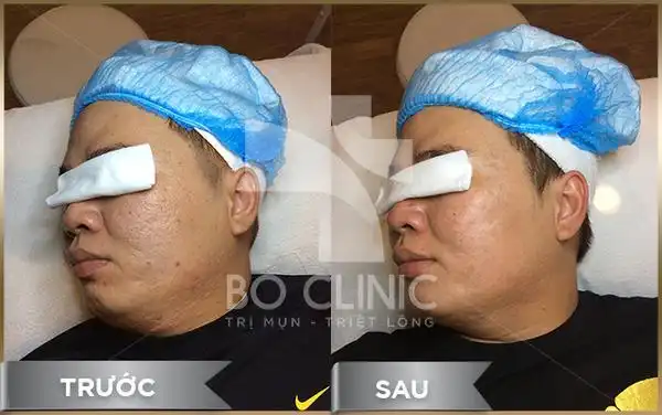 spa trị mụn cho nam tphcm