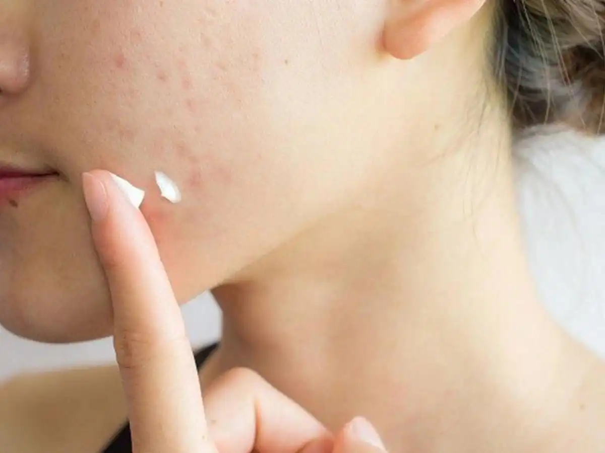 Sử dụng mẹo che mụn và thâm bằng các cách sau Sử dụng mẹo che mụn và thâm bằng các cách sau