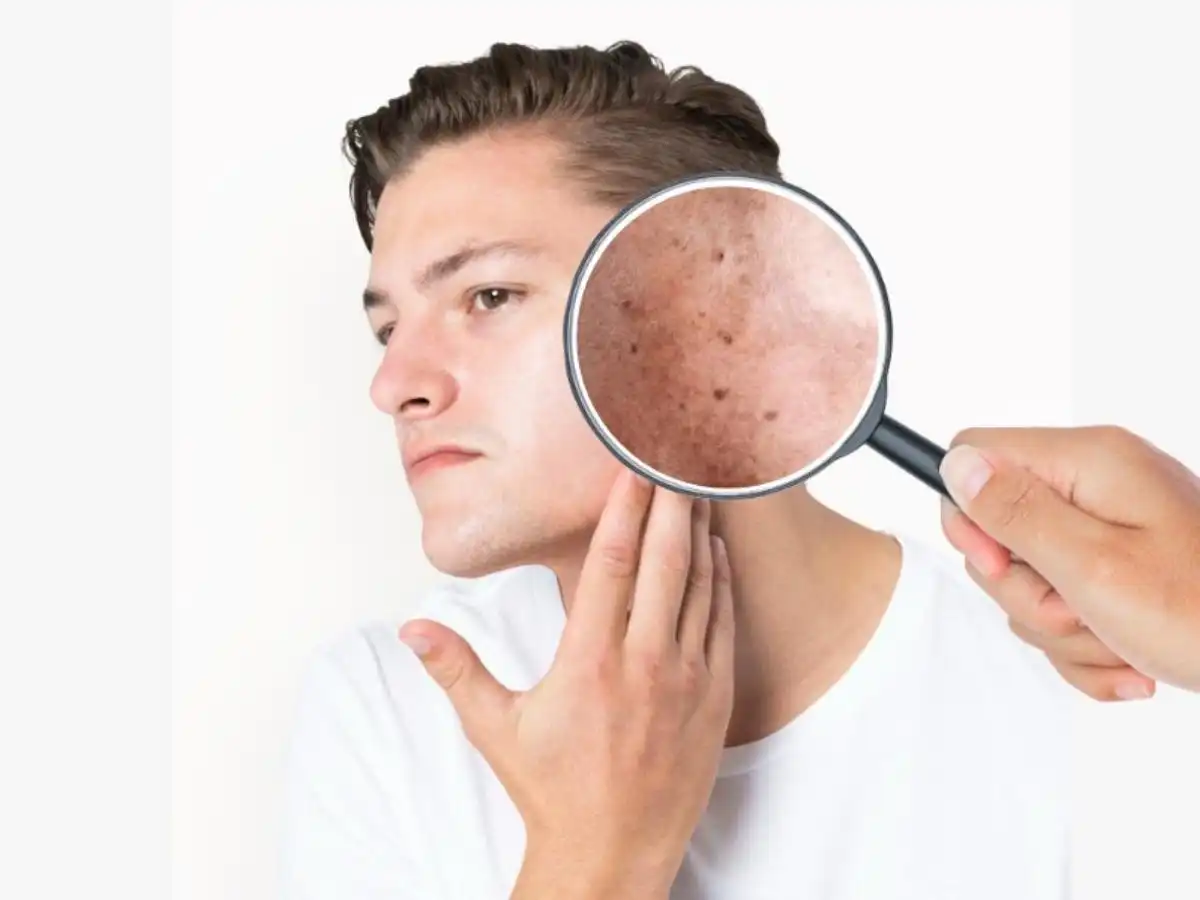 Tia UVA/UVB tác động làm tăng Melanin và phá hủy collagen trên da nam giới