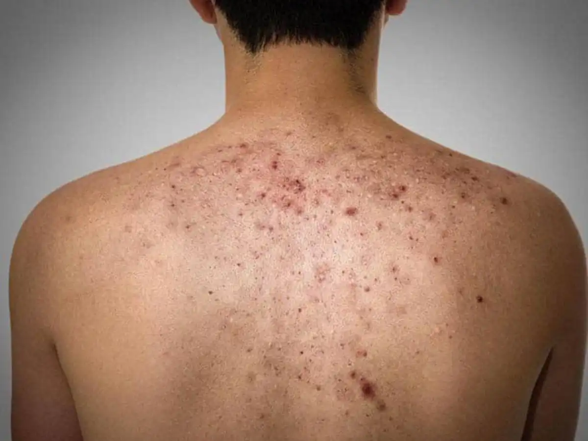 Tránh xa các chất làm mụn năng hơn